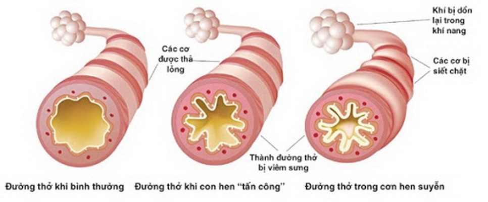 Hình ảnh đường thở ở người bị hen phế quản.